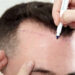 Murió en agonía: se somete a un trasplante de pelo y fallece